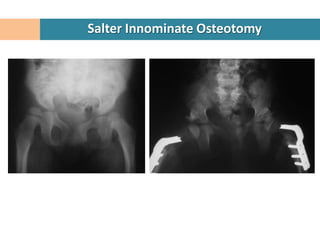 Salter Innominate Osteotomy
 