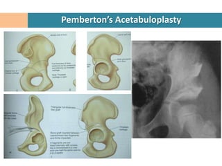 Pemberton’s Acetabuloplasty
 