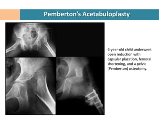 Pemberton’s Acetabuloplasty



                    6-year-old child underwent
                    open reduction with
                    capsular placation, femoral
                    shortening, and a pelvic
                    (Pemberton) osteotomy.
 