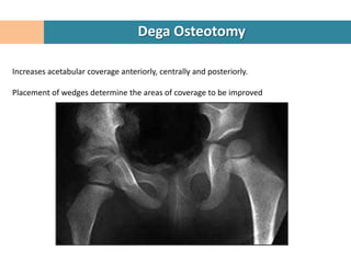 Dega Osteotomy

Increases acetabular coverage anteriorly, centrally and posteriorly.

Placement of wedges determine the areas of coverage to be improved
 