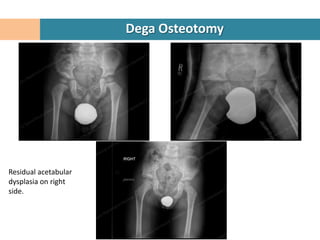 Dega Osteotomy




Residual acetabular
dysplasia on right
side.
 