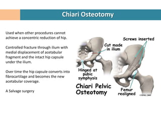 Chiari Osteotomy

Used when other procedures cannot
achieve a concentric reduction of hip.

Controlled fracture through ilium with
medial displacement of acetabular
fragment and the intact hip capsule
under the ilium.

Over time the hip capsule converts into
fibrocartilage and becomes the new
acetabular coverage.

A Salvage surgery
 