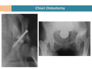 Chiari Osteotomy
 