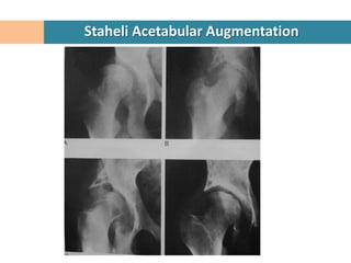 Staheli Acetabular Augmentation
 