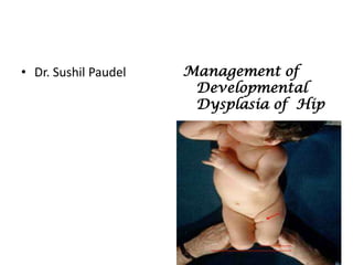 • Dr. Sushil Paudel   Management of
                       Developmental
                       Dysplasia of Hip
 