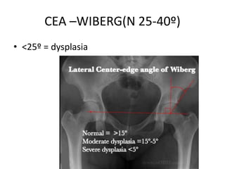 Developmental Dysplasia Hip | PPTX