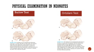 Barwal Test Developmental dysplasia of the hip literature | PPTX