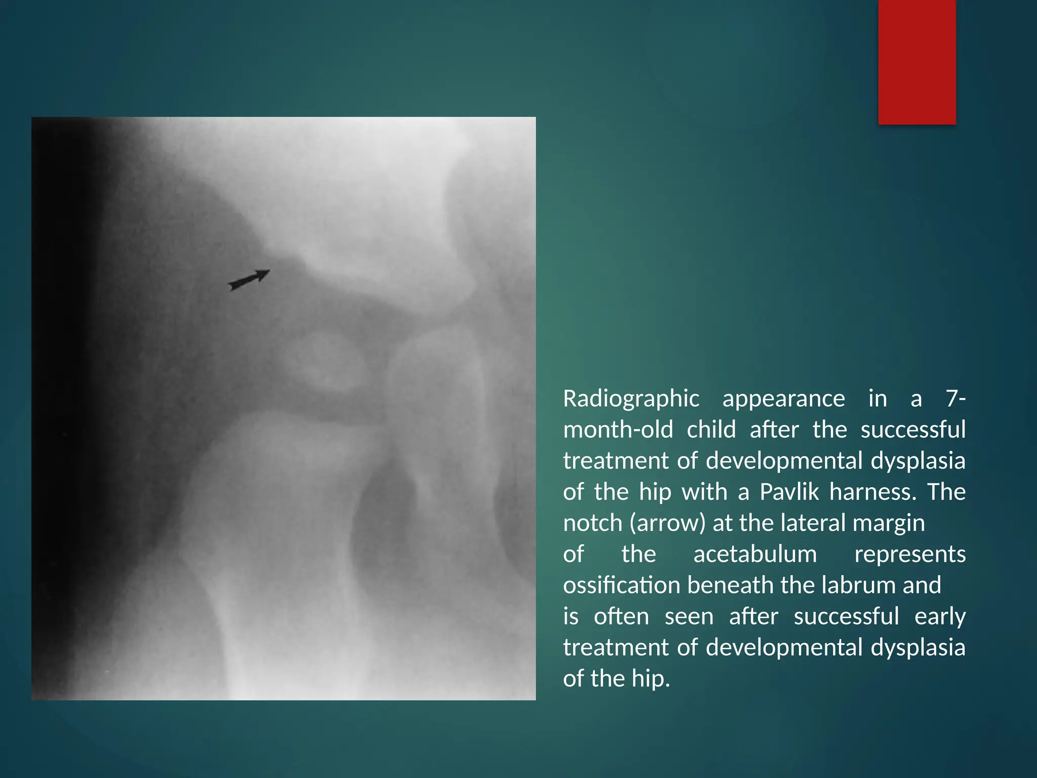developmental dysplasia of the hip or DDH.pptx