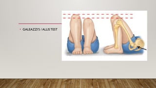 Clinical accessment of developmental dysplasia of hip | PPTX