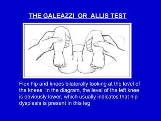 Comprehensive Overview of Developmental Dysplasia of the Hip (DDH) in ...