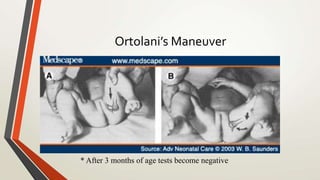 Ortolani’s Maneuver
* After 3 months of age tests become negative
 