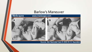Barlow’s Maneuver
 