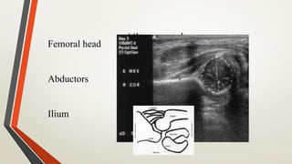UltrasoundFemoral head
Abductors
Ilium
 