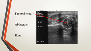 UltrasoundFemoral head
Abductors
Ilium
 
