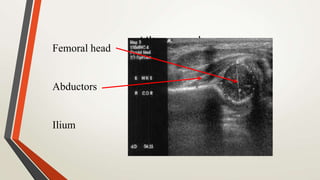 UltrasoundFemoral head
Abductors
Ilium
 