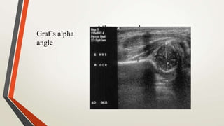 UltrasoundGraf’s alpha
angle
 