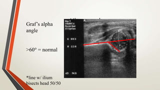 UltrasoundGraf’s alpha
angle
>60 = normal
*line w/ ilium
bisects head 50/50
 