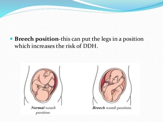 Sleeping positions to turn breech baby picture