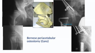 DDH in ADOLESCENTS overview of diagnosis and treatment.pptx