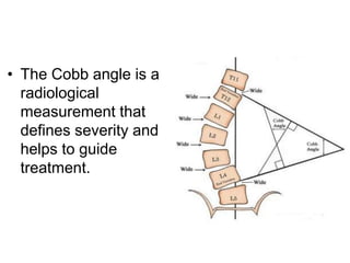 • The Cobb angle is a
radiological
measurement that
defines severity and
helps to guide
treatment.
 