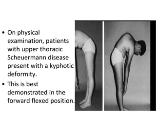 • On physical
examination, patients
with upper thoracic
Scheuermann disease
present with a kyphotic
deformity.
• This is best
demonstrated in the
forward flexed position.
 