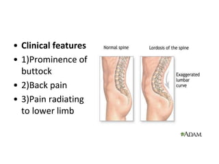 • Clinical features
• 1)Prominence of
buttock
• 2)Back pain
• 3)Pain radiating
to lower limb
 