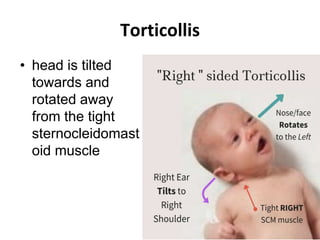 Torticollis
• head is tilted
towards and
rotated away
from the tight
sternocleidomast
oid muscle
 