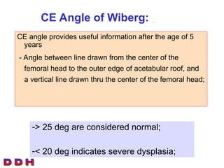 DDH Developmental Dysplasia of the Hip.ppt