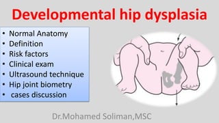 Developmental hip dysplasia
Dr.Mohamed Soliman,MSC
• Normal Anatomy
• Definition
• Risk factors
• Clinical exam
• Ultrasound technique
• Hip joint biometry
• cases discussion
 