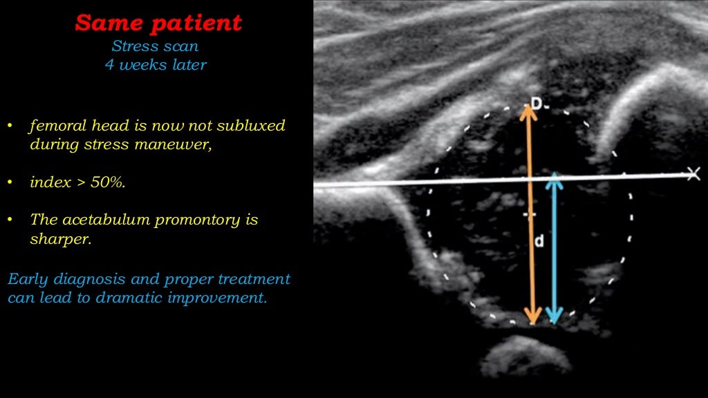 Ultrasound of Developmental dysplasia of hip Joint ..Dr.Mohamed Solim…