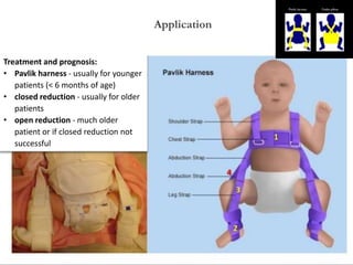 Treatment and prognosis:
• Pavlik harness - usually for younger
patients (< 6 months of age)
• closed reduction - usually for older
patients
• open reduction - much older
patient or if closed reduction not
successful
Application
 