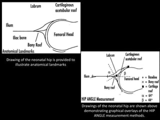 Drawing of the neonatal hip is provided to
illustrate anatomical landmarks
Drawings of the neonatal hip are shown above
demonstrating graphical overlays of the HIP
ANGLE measurement methods.
 