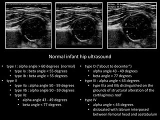 Normal infant hip ultrasound
• type I : alpha angle > 60 degrees (normal)
• type Ia : beta angle < 55 degrees
• type Ib : beta angle > 55 degrees
• type II
• type IIa : alpha angle 50 - 59 degrees
• type IIb : alpha angle 50 - 59 degrees
• type IIc
• alpha angle 43 - 49 degrees
• beta angle < 77 degrees
• type D ("about to decenter")
• alpha angle 43 - 49 degrees
• beta angle > 77 degrees
• type III : alpha angle < 43 degrees
• type IIIa and IIIb distinguished on the
grounds of structural alteration of the
cartilaginous roof
• type IV
• alpha angle < 43 degrees
• dislocated with labrum interposed
between femoral head and acetabulum
 