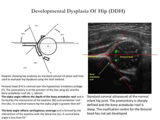 Developmental Dysplasia Of Hip (DDH)
 