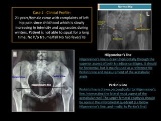 Case 2 : Clinical Profile:
21 years/female came with complaints of left
hip pain since childhood which is slowly
increasing in intensity and aggravates during
winters. Patient is not able to squat for a long
time. No h/o trauma/fall No h/o fever/TB
Hilgenreiner's line
Hilgenreiner's line is drawn horizontally through the
superior aspect of both triradiate cartilages. It should
be horizontal, but is mainly used as a reference for
Perkin's line and measurement of the acetabular
angle
Perkin's line
Perkin's line is drawn perpendicular to Hilgenreiner's
line, intersecting the lateral most aspect of the
acetabular roof. The upper femoral epiphysis should
be seen in the inferomedial quadrant (i.e below
Hilgenreiner's line, and medial to Perkin's line)
 