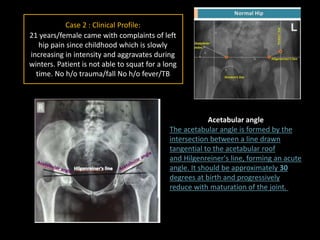 Case 2 : Clinical Profile:
21 years/female came with complaints of left
hip pain since childhood which is slowly
increasing in intensity and aggravates during
winters. Patient is not able to squat for a long
time. No h/o trauma/fall No h/o fever/TB
Acetabular angle
The acetabular angle is formed by the
intersection between a line drawn
tangential to the acetabular roof
and Hilgenreiner's line, forming an acute
angle. It should be approximately 30
degrees at birth and progressively
reduce with maturation of the joint.
 