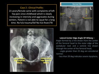 Case 2 : Clinical Profile:
21 years/female came with complaints of left
hip pain since childhood which is slowly
increasing in intensity and aggravates during
winters. Patient is not able to squat for a long
time. No h/o trauma/fall No h/o fever/TB
Lateral Center Edge Angle Of Wiberg –
Angle formed by a line drawn from the center
of the femoral head to the outer edge of the
acetabular roof, and a verticle line drawn
through the center of the femoral head;
- angle greater than 25 deg are considered
normal;
- less than 20 deg indicates severe dysplasia;
 