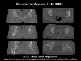 Developmental Dysplasia Of Hip (DDH)
Coronal and Axial CT Scan Images reveals –
Subarticular sclerosis, subarticular geords, shallow acetlabulum, malformed femoral head
 