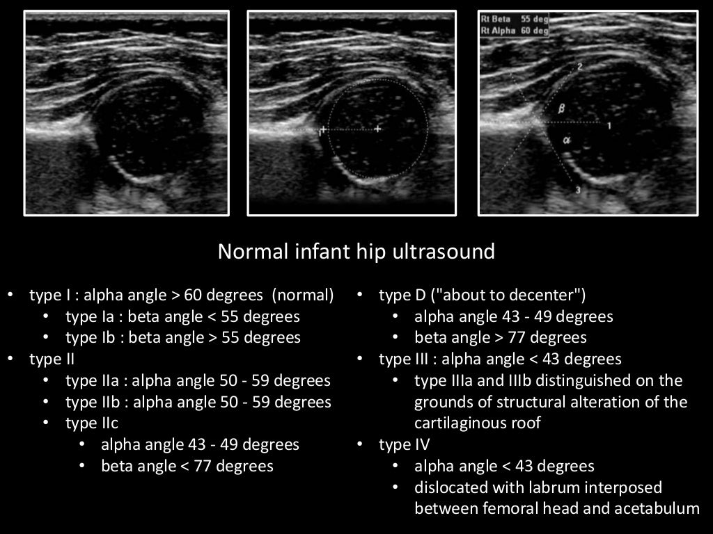 Hip joint, ultrasound: norm in newborns Hip joint, ultrasound: norm in newborns