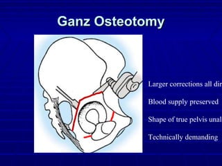 Ganz OsteotomyGanz Osteotomy
Larger corrections all dire
Blood supply preserved
Shape of true pelvis unalt
Technically demanding
 