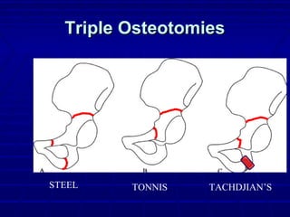 Triple OsteotomiesTriple Osteotomies
STEEL TONNIS TACHDJIAN’S
 