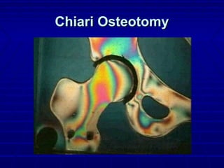Chiari OsteotomyChiari Osteotomy
 