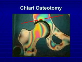 Chiari OsteotomyChiari Osteotomy
 