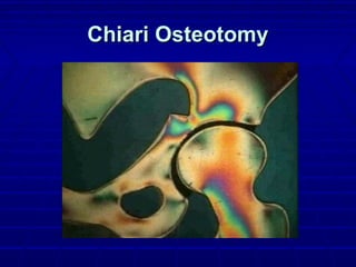 Chiari OsteotomyChiari Osteotomy
 