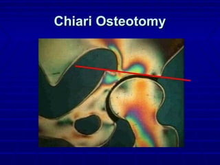 Chiari OsteotomyChiari Osteotomy
 