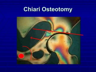 Chiari OsteotomyChiari Osteotomy
 