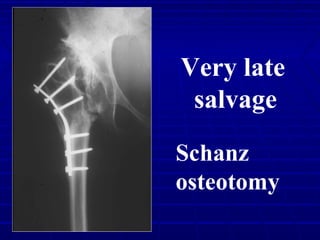 Schanz
osteotomy
Very late
salvage
 