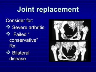Joint replacementJoint replacement
Consider for:Consider for:
 Severe arthritisSevere arthritis
 Failed “Failed “
conservative”conservative”
Rx.Rx.
 BilateralBilateral
diseasedisease
 