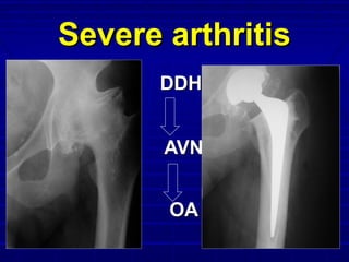 Severe arthritisSevere arthritis
DDHDDH
AVNAVN
OAOA
 