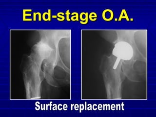 End-stage O.A.End-stage O.A.
 